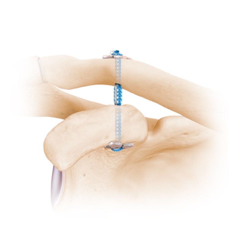 Luxacion de Hombro Acromio Clavicular tratamiento Luxacion de Hombro Acromio Clavicular tratamiento